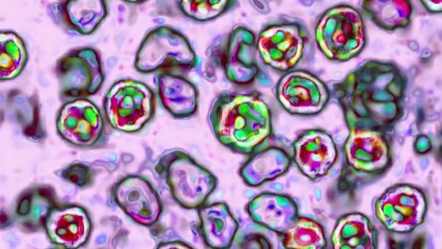 Pennsylvania reports fourth death linked to measles​Pennsylvania reports fourth death linked to measles 