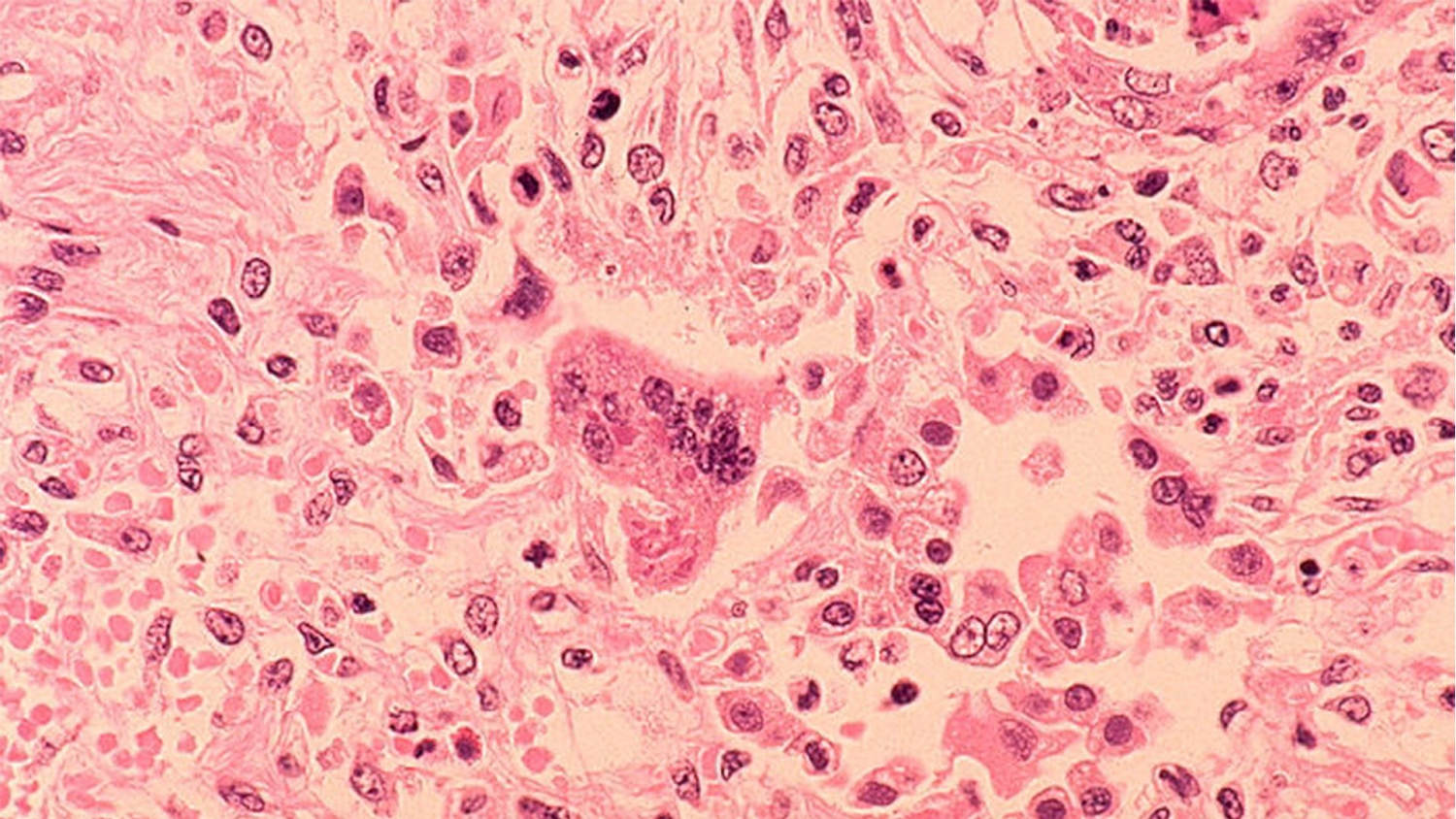 Doctors in Pennsylvania estimate at least six babies have been born with measles​Doctors in Pennsylvania estimate at least six babies have been born with measles 