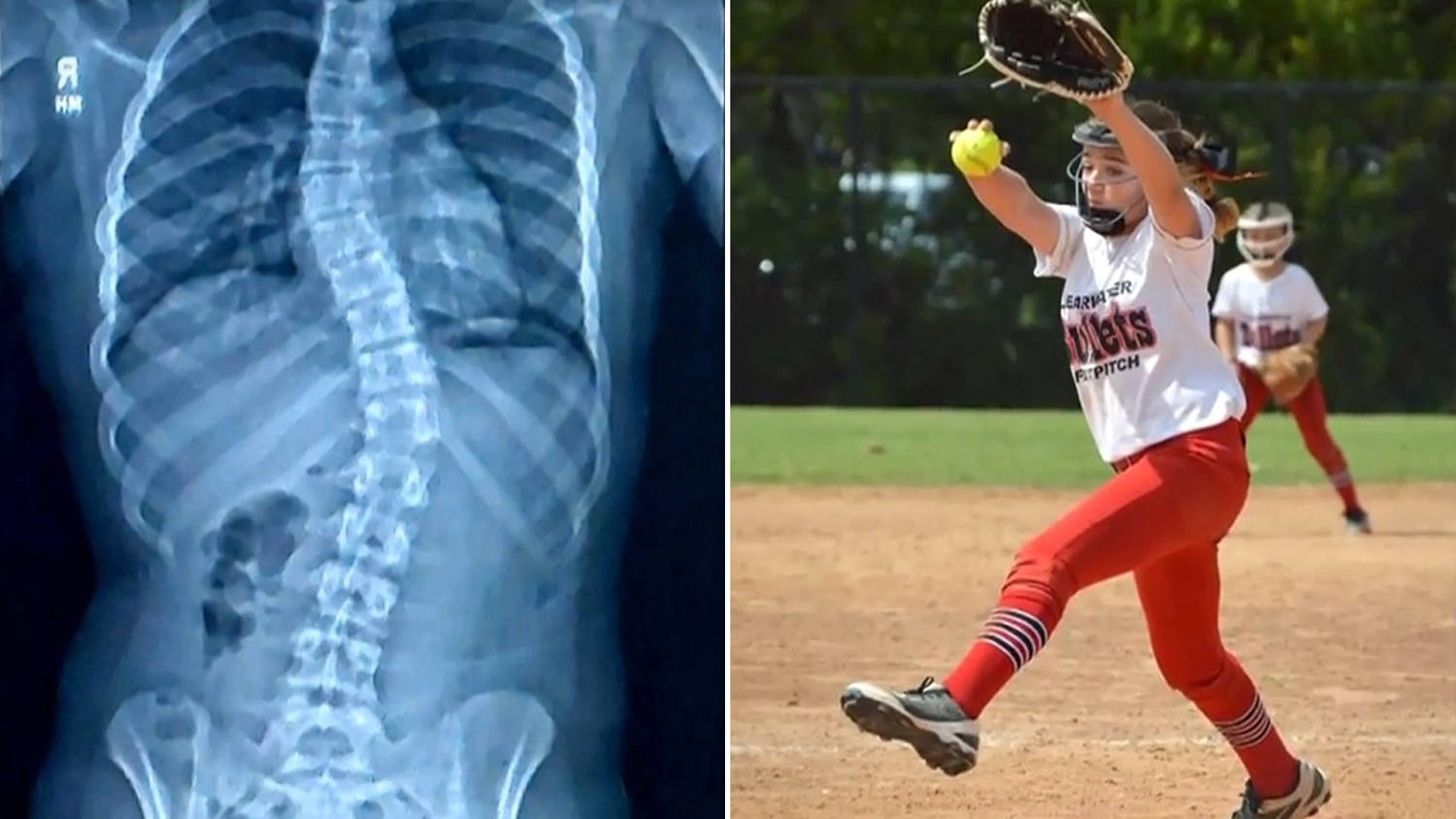 How This Teen’s Health Journey Shaped Her Passion for Softball​How This Teen’s Health Journey Shaped Her Passion for Softball 