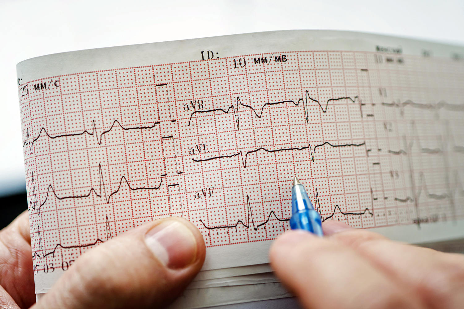 Sudden cardiac arrest deaths declining in college athletes, new research shows
