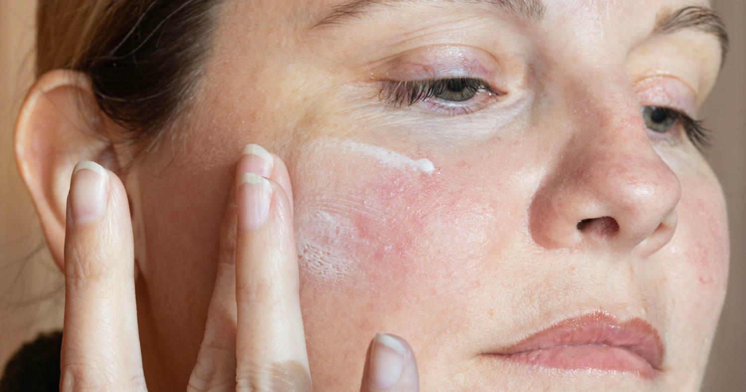 Derm-approved skin care to soothe rosacea and redness