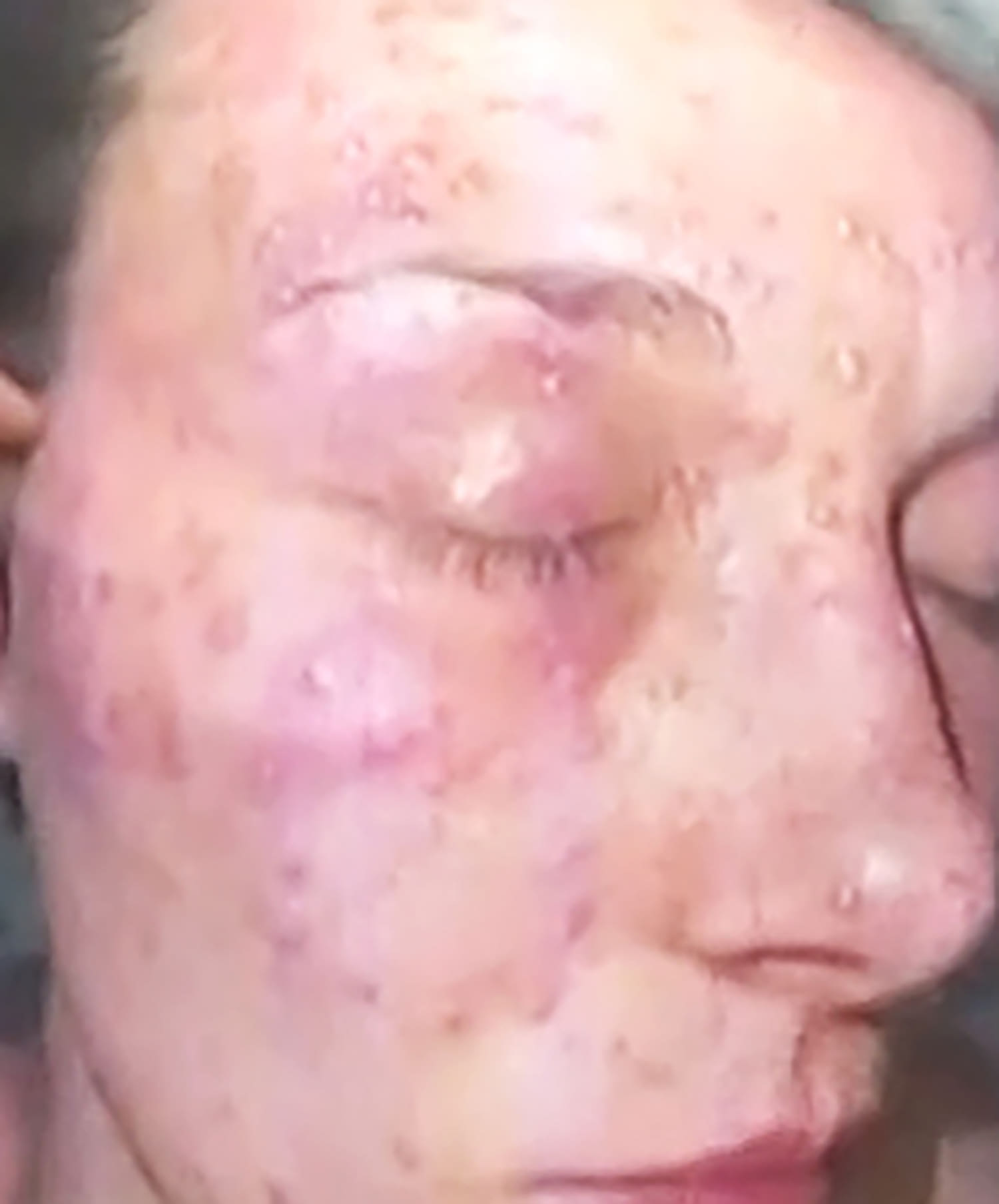 Texas mom says police held her face in pile of fire ants, covering head and neck with hundreds of bite marks