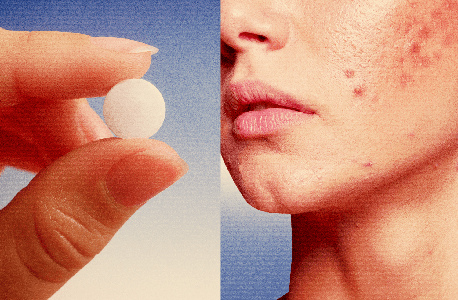 The most popular pill to treat women's acne is a blood pressure drug