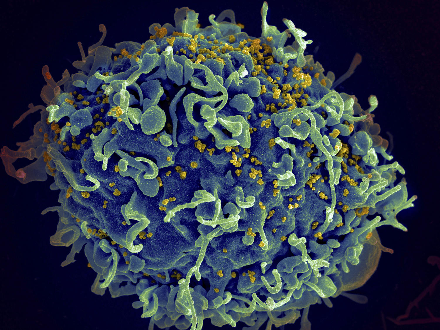 A 7th person with HIV is probably cured after stem cell transplant for leukemia, scientists say