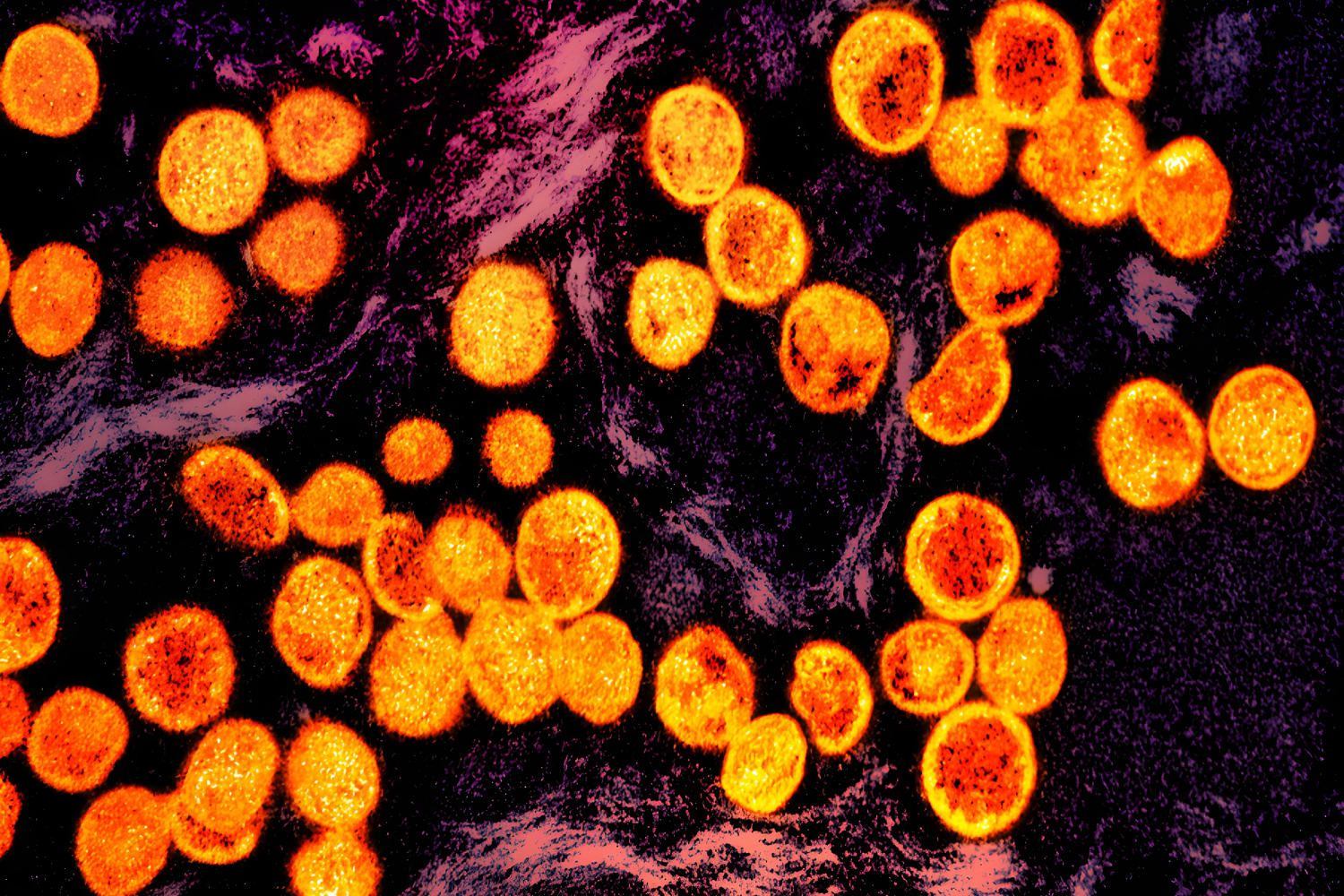 Sweden confirms a case of mpox — the first reported infection of the strain outside of Africa