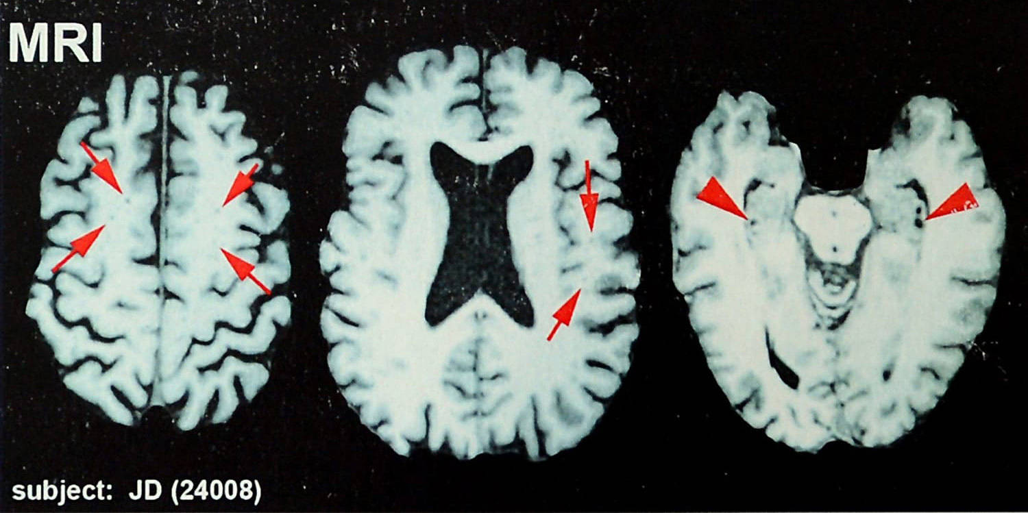 A third of former NFL players surveyed think they have CTE: study