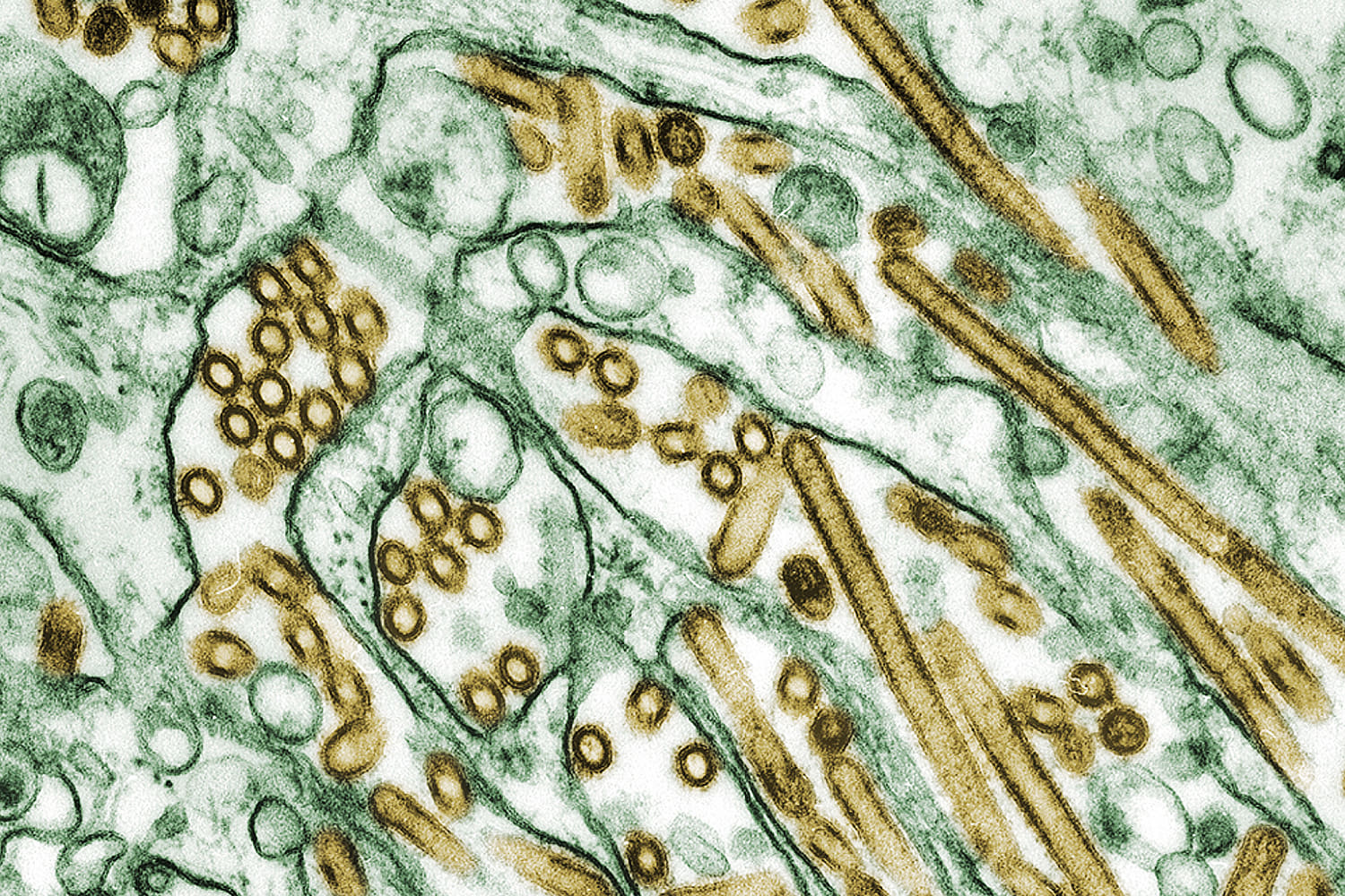 Teen with bird flu in Canada hospitalized in critical condition