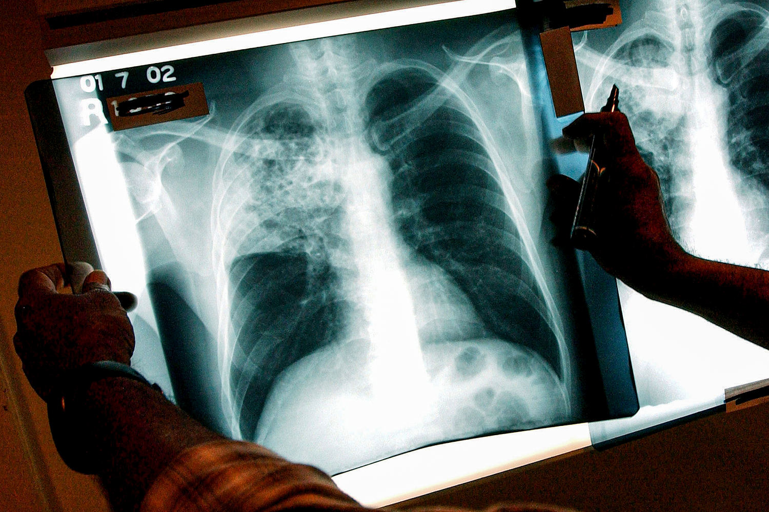 Tuberculosis outbreak that has killed 2 in Kansas grows