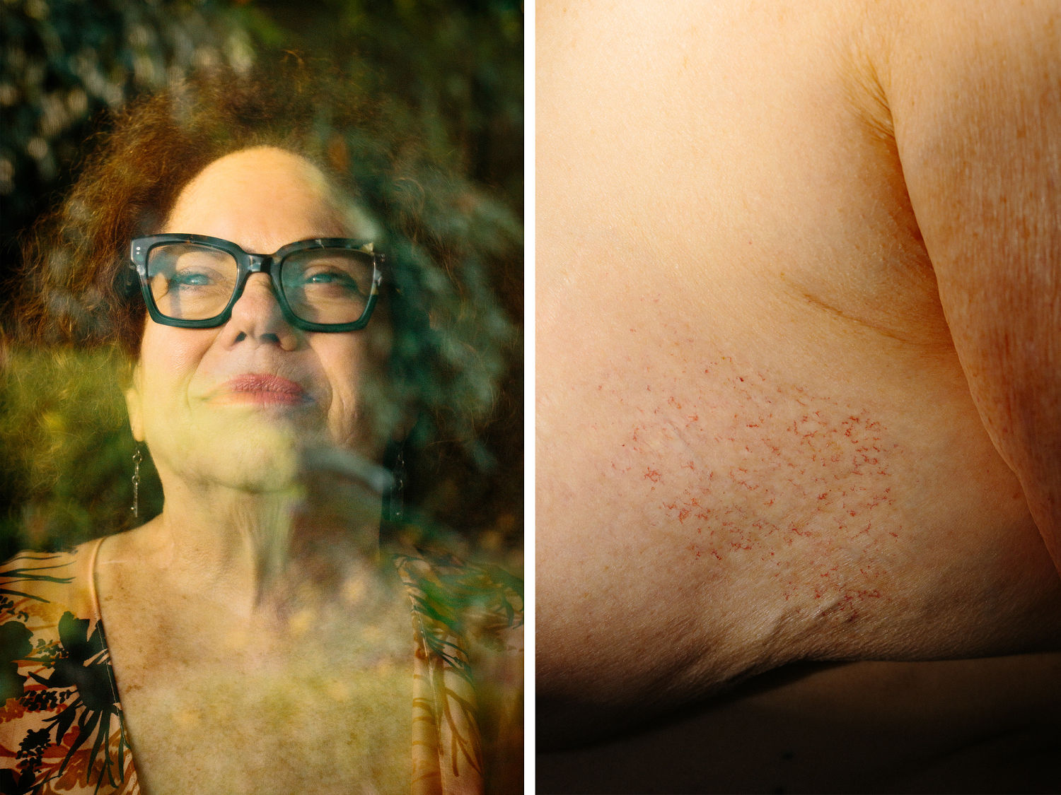 U.S. women are increasingly shut out of a breast cancer treatment valued around the world
