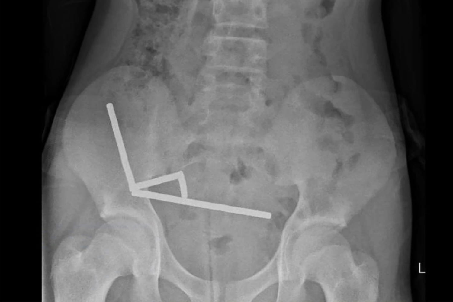 Boy who swallowed 100 magnets has surgery to remove them from his gut
