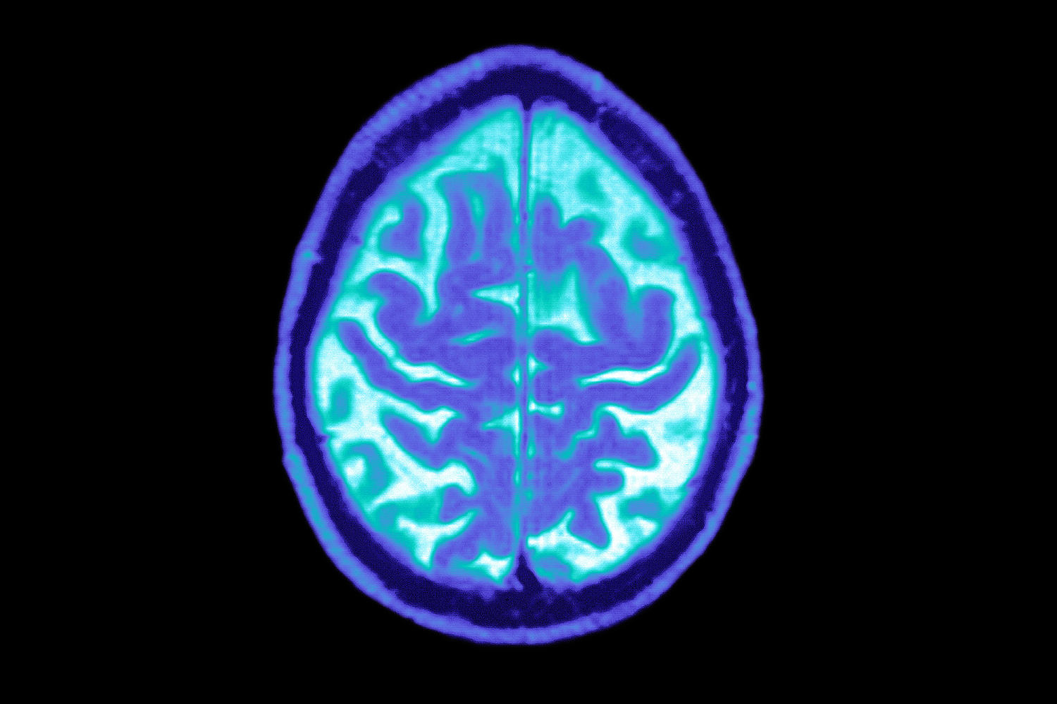 Novo Nordisk still sees potential for GLP-1 drugs for Alzheimer’s, despite trial setback