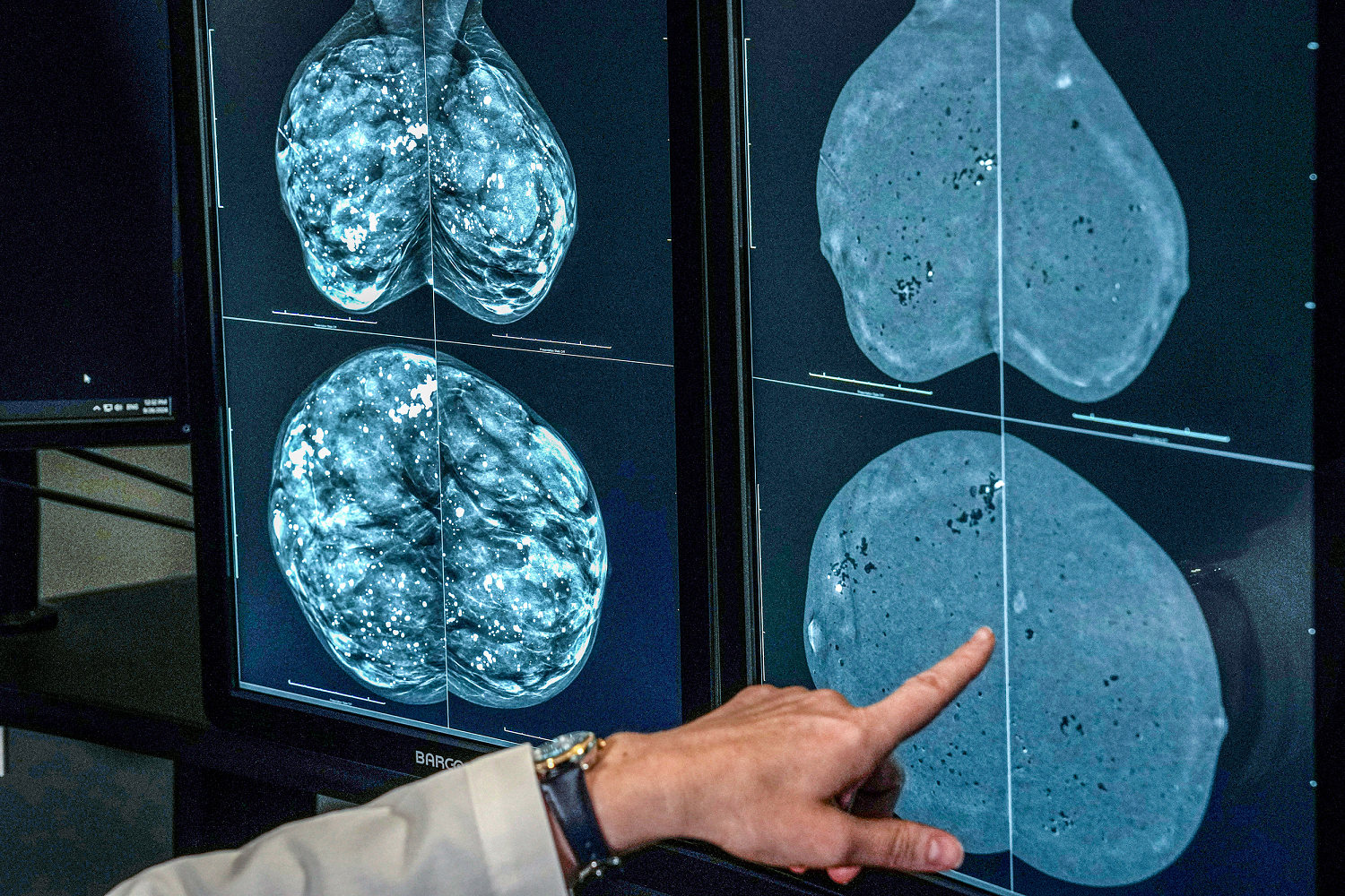 When should you get a mammogram? Conflicting advice makes it hard to know