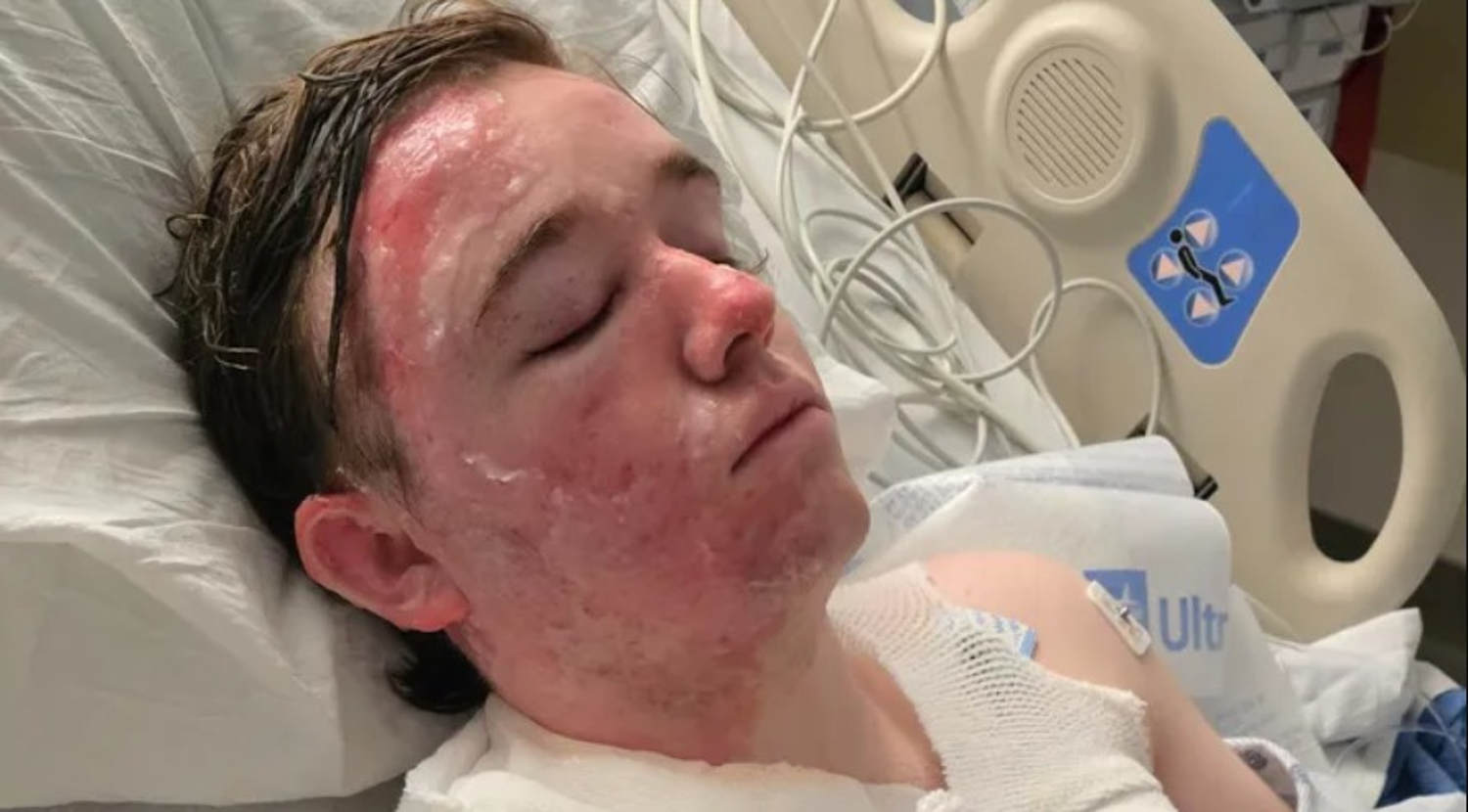 McDonald’s worker suffers severe burns on face and body after coworker throws hot oil on him