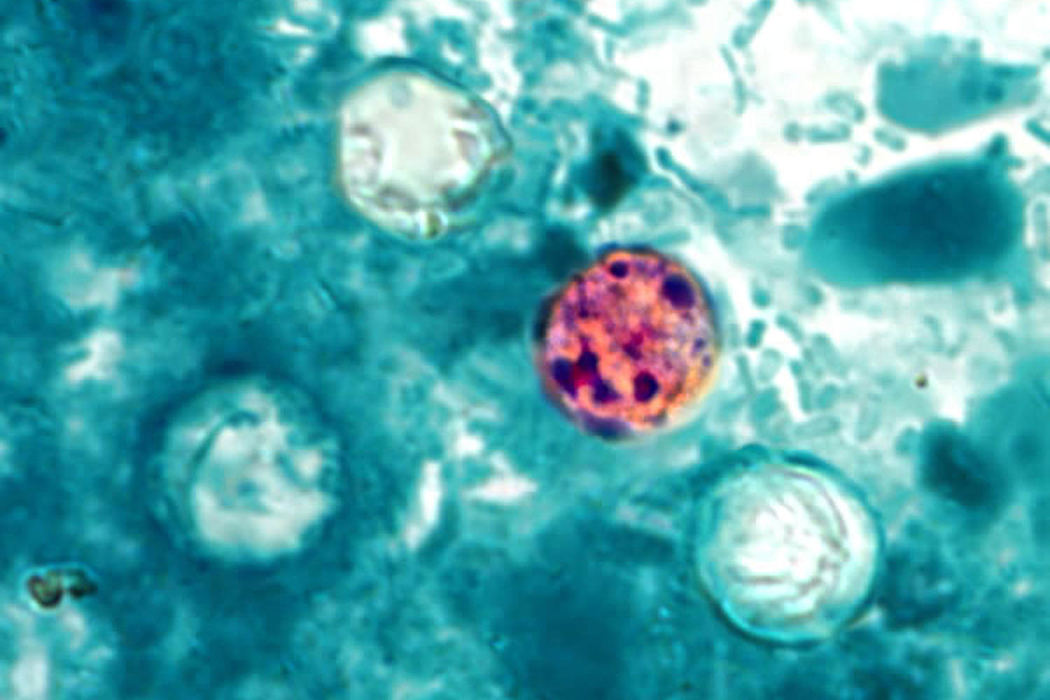 Nearly 7,000 cases of cyclosporiasis confirmed or under investigation nationwide, CDC says