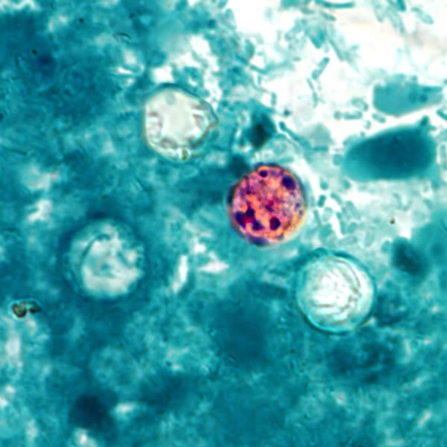 86 people have been hospitalized with the foodborne parasite spreading across the U.S., the CDC said