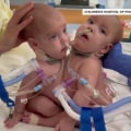 Meet the surgeon who led life-changing procedure to separate conjoined twins