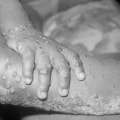 Officials investigate possible case of monkeypox in New York