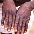 How to identify a monkeypox rash: Symptoms to look out for