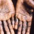 CDC tracking 9 cases of monkeypox across 7 states