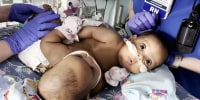 Conjoined twins successfully separated in rare surgery