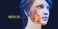 Buccal fat removal: Inside latest trend to reshape the face