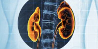 Black patients face historically longer waiting times for kidney transplants due to outdated test