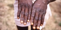 Hands of a monkeypox case patient in the Democratic Republic of the Congo in 1997.
