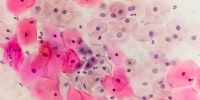 Paps smear under microscopy showing inflammatory smear with hpv related changes. Cervical cancer. SCC