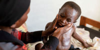 Mpox surge in Central Africa exposes awareness gap