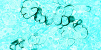 Human tumor cells from the pancreas stained with an immunocytochemical stain with methyl green in the background and magnified to 400x.