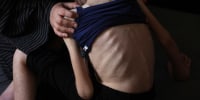 The back of a 12 year old girl showing her protruding ribs.