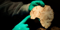 A doctor holds brain tissue