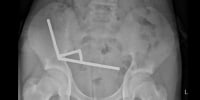 Teen swallows magnets