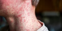Skin covered with measles rash.