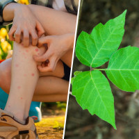 Left: Mosquito bites
Center: Poison Ivy vine
Right: Sunburn