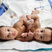 Formerly conjoined twins