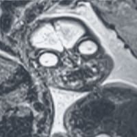 spooky fetal MRI image