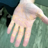 Cholesterol hands