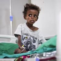 A malnourished child in a gray t-shirt sitting on a hospital bed.