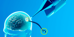 Implante cerebral