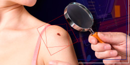Nueva tecnología 3D podría detectar cáncer de piel en tan solo 12 minutos