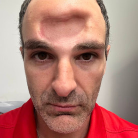 Ido Simyoni, fibrous Dysplasia
