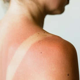 Close-up of a sunburn marks on a woman's back.