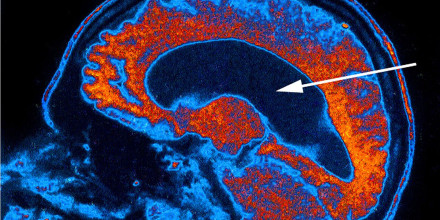 Un escaneo cerebral que muestra hidrocefalia, que sucede cuando hay un exceso de líquido cefalorraquídeo en los ventrículos.