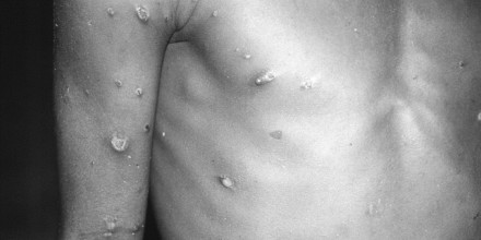 A patient displays a number of lesions from what had been an active case of monkeypox in 1997.