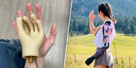 Chloé Toscano wears her prosthetic arm.