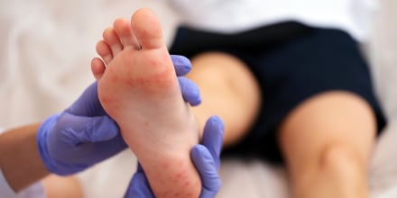 Coxsackie virus rash (hand foot and mouth disease).