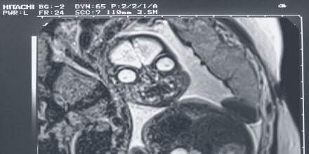 spooky fetal MRI image