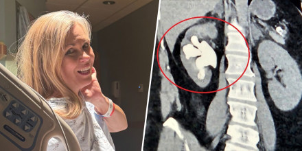 split image: Chrissi Anderson / x-ray of kidney stone