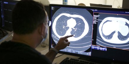 Fármaco para el cáncer de páncreas recién aprobado se muestra prometedor en pulmones también